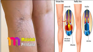 Memar adalah akibat cedera atau luka di kulit yang ini akan membantu menghilangkan darah yang terperangkap di area yang memar. Cara Menghapuskan Urat Timbul Di Kaki Dengan Menggunakan Bawang Putih Majalah Perdana