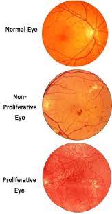Diabetic Retinopathy Women Fitness Diabetic Retinopathy Diabetes Eye Facts