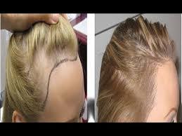زراعة الشعر بالليزر وكيفيته طريقة زراعة الشعر بالليزر خطوات زراعة الشعر بالليزر سعر تكلفة زراعة الشعر بالليزر