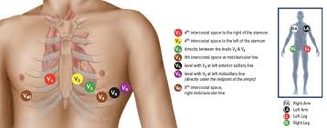 Lead Placement 12 Lead Ekg Placement Ekg Placement