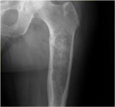 Image result for Chondrosarcoma
