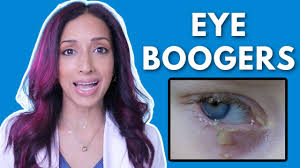 Image result for Eye Discharge