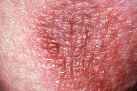Image result for scabies on genitals