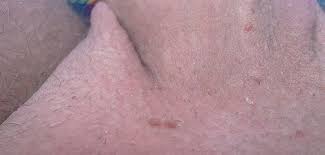 While the detection rate for via dropped to 0.5% with declining test positivity during the course of the study, it remained constant for cytology and hpv testing. Hpv Britische Forscher Fordern Impfung Fur Schwule Jugendliche Queer De