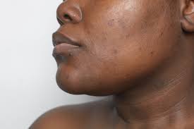 Image result for Postinflammatory Hypopigmentation