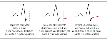 Segmento ST | Valoracion y Analisis del Segmento ST