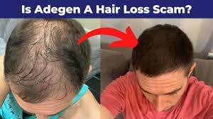 Keeps and hims both offer prescription and over the counter hair loss treatment options. Is Adegen A Hair Loss Scam Reviews Of Adegen Hair Loss Results Youtube