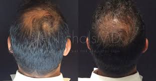 Itching, scabs, and dry flakes of skin that fall off and stick to the hair are symptoms. Hair Loss Scalp Conditions Nicholsmd Of Greenwich