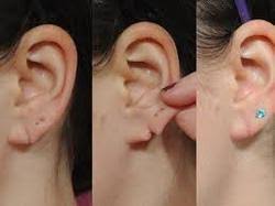 The use of lidocaine with epinephrine is beneficial for earlobe repairs because it decreases the amount of blood in the field, prolongs anesthesia, reduces the time of the procedure and is supported in the medical literature. Ear Lobe Repair Ear Treatment Tiruvalla Medicle Machine Hospital Tiruvalla Id 6936789830