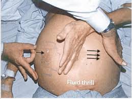 Image result for Shifting Dullness Test