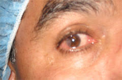 Best Pterygium Surgeon Thousand Oaks Oxnard Los Angeles