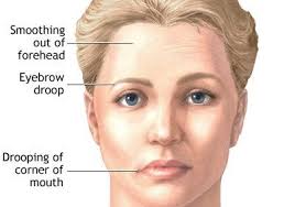 It results in weakness of the skeletal muscles and can. Miastenia Gravis O Que E Miastenia Gravis Tratamento E Prevencao