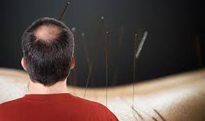 Also, learn how to stop hair fall (loss) using acupressure therapy. Hair Loss Treatment Try Acupuncture To Stimulate Hair Growth Express Co Uk