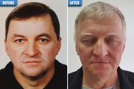 Medical conditions that may explain hair bleaching Man S Hair Turns White Overnight In First Case Of Rare Side Effect To Kidney Cancer Treatment