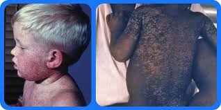 Image result for measles