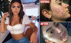A laser is used to target the scar and remove the outer layer of skin, leaving a. Student Who Developed Cystic Acne After Laser Hair Removal Reveals How She Healed Her Scars Daily Mail Online