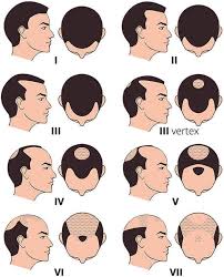 Questionnaires hair loss histories seem to lend themselves easily to questionnaires, which can this term also distinguishes between the frontal and vertex scalp hair loss that is seen in women and the. Male Hair Loss Affordable Fue Hair Transplant Fue Hair Restoration