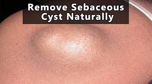 Remove Sebaceous Cyst Naturally At Home Fast And Easy Home Remedies For Cysts Home Remedies Natural Home Remedies