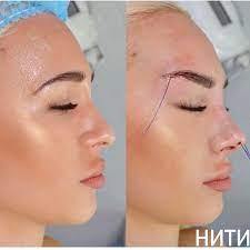 An eyebrow lift or thread lift is a type of procedure wherein temporary sutures are used to produce a subtle but visible lift in the skin. Cosmetic Insider S Instagram Photo Fox Eyes Pdo Threading And Botox To Lift The Eyebrows What Do Eyebrow Lift Botox Eyebrow Lift Fox Eyes