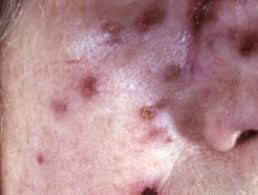 pathomechanism of bazin's tuberculosis indurativa. Tuberculids Dermnet Nz