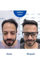 Miles de pacientes con más cabello. Eso queremos seguir logrando en  Capilea. ¿Quieres dar el primer paso? No lo pienses más. Aquí te esperamos.  📍 C/ Montesa 31