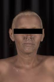 JEADV Clinical Practice: Vol 4, No 4