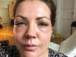 Medicinsk hudvård, dermapen, plasmapen, kosmetisk samt medicinsk tatuering phibrows, mm. Svider Efter Dermapen