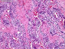 Image result for Glomus tumor