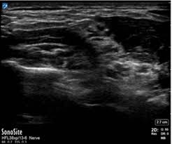 Image result for Superior Trunk Block