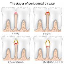 Check spelling or type a new query. What Are The Causes Of Loose Teeth In Adults With Pictures
