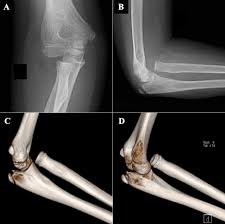 Image result for Radial Head Dislocation
