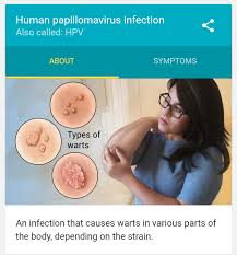 Image result for human papillomavirus symptoms