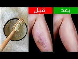 علاج دوالى الخصية بدون جراحة ,علاج دوالى الساقين بدون جراحة , افضل دكتور اشعة تداخلية ,علاج اورام الكبد بالتردد الحرارى ,علاج اورام الكبد بالحقن ,علاج تضخم البروستاتا الحميد ,علاج الاورام الليفية بدون جراحة ,علاج اورام الكبد , علاج دوالي. Ø¹Ù„Ø§Ø¬ Ø§Ù„Ø¯ÙˆØ§Ù„ÙŠ Ø¨Ø§Ù„Ø§Ø¹Ø´Ø§Ø¨