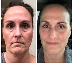 Wrinkle and dark circle remedies for over 40s?