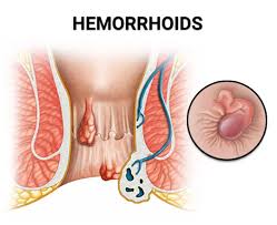 Image result for Hemorrhoid
