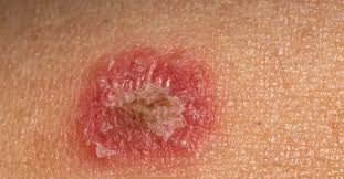 Can hand sanitizer kill ringworm? Psoriasis Or Ringworm Symptoms Treatment And Other Rashes