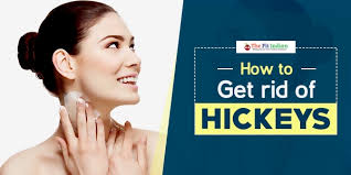 See full list on 54health.com 10 Simple Home Remedies To Get Rid Of Hickeys Super Quick