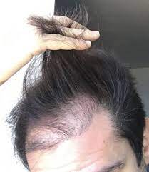 Trapianto di capelli senza rasatura. Trapianto Des Fue Senza Rasatura