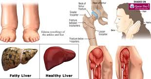 Signs Symptoms Of Protein Deficiency