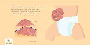 Gastroschisis Adalah Cacat Lahir Langka Dan Ditandai Dengan Usus Bayi Berada Di Luar Tubuh Akibat Adanya Lubang Pada Dinding Perut Bay Tubuh Kelahiran Penyakit