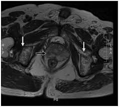 In published clinical trials, the most commonly used imaging modalities for the detection and evaluation of therapeutic response are bone scan, abdominopelvic … Prostatic Metastases And Polycythemia Vera On Bone Magnetic Resonance Imaging A Case Report