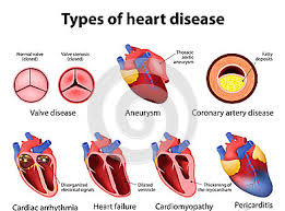 Heart Failure Sometimes Known As Congestive Heart Failure Occurs When Your Heart Muscle Doesn T Pum Coronary Arteries Coronary Artery Disease Cardiac Disease