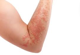 The welts vary in size and appear and fade repeatedly as the reaction runs its course. Hives Common Causes More Honorhealth