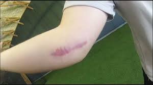 The recovery process takes time and it will be uncomfortable. More Younger Pitchers Now Get Tommy John Surgery