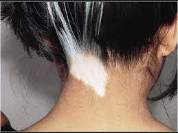 But, problems like white patches also occur in human beings. White Patches On Skin White Spots On Skin Fungus Vitiligo Skin Disease Vitiligo Patches Vitiligo Treatment Vitiligo Skin Vitiligo