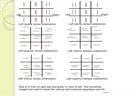 Diplopia Charting