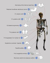 There are 2 main types of bone tissue. Skeletal Anomalies In The Neandertal Family Of El Sidron Spain Support A Role Of Inbreeding In Neandertal Extinction Scientific Reports