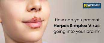 Protecting your brain: Measures to avoid the herpes simplex virus