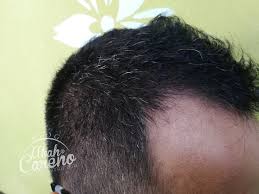 Dalam kasus autoimun alopecia dan vitiligo, sistem kekebalan tubuh dapat menyerang rambut dan menyebabkan hilangnya pigmen pewarna rambut. Pomade Khas Untuk Lebatkan Rambut Dan Hitamkan Rambut Uban Blog Abah Careno