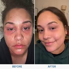 Image result for ekzema face